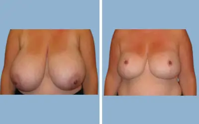 Before and After